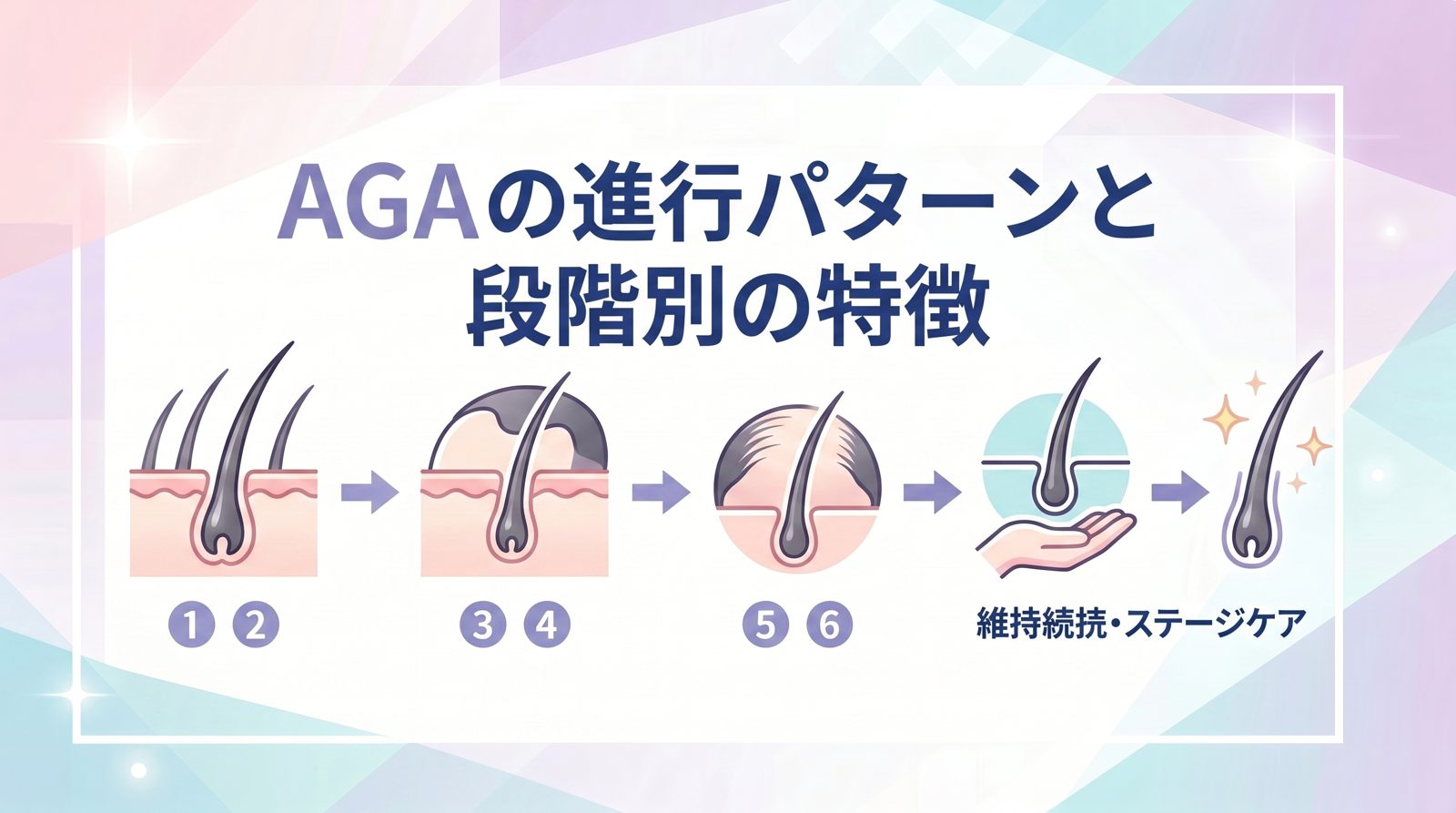 AGAの進行パターンと段階別の特徴