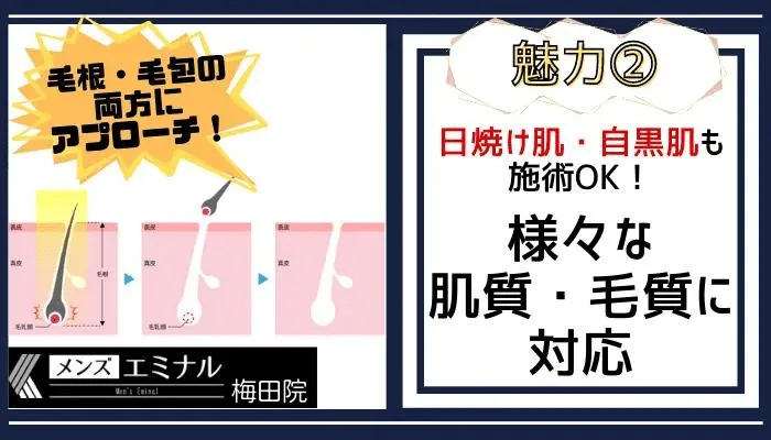 メンズエミナル梅田脱毛機特徴2