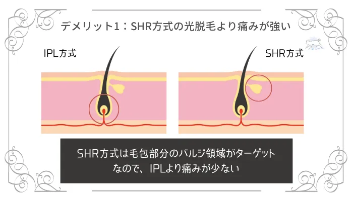 IPL脱毛のデメリット1