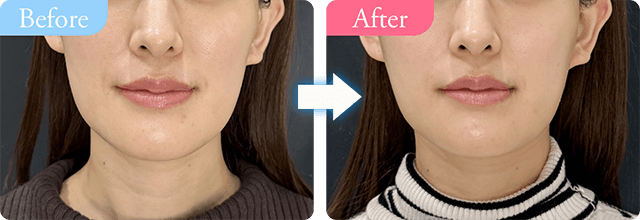 beforem→after写真