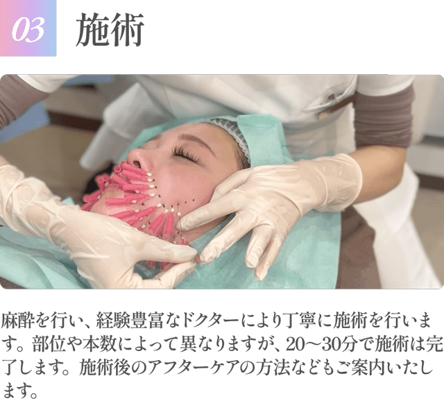 【03施術】麻酔を行い、経験豊富なドクターにより丁寧に施術を行います。部位や本数によって異なりますが、20～30分で施術は完了します。施術後のアフターケアの方法などもご案内いたします。