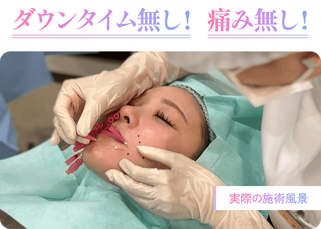ダウンタイム無し！痛み無し！