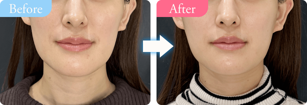 beforem→after写真