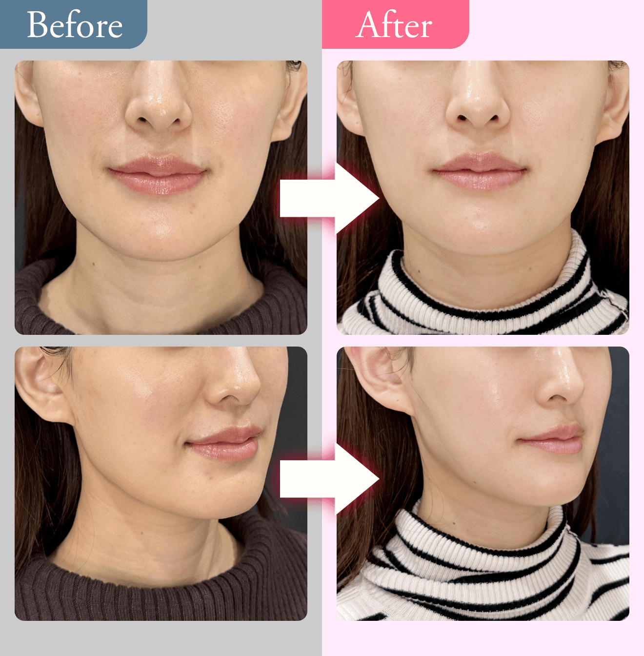 beforem→after写真