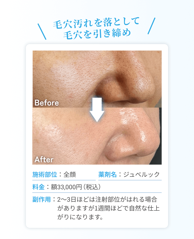 毛穴を引き締め！施術部位：全顔 | 薬剤名：ジュべルック | 料金：額33,000円（税込）| 副作用：2~3日ほどは注射部位がはれる場合がありますが1週間ほどで自然な仕上がりになります。