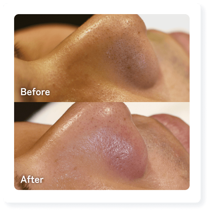 施術部位：全顔 | 施術名：新・水光注射（メソガン） | 料金：額33,000円（税込） | 副作用：2～3日ほどは注射部位がはれる場合がありますが1週間ほどで自然な仕上がりになります。