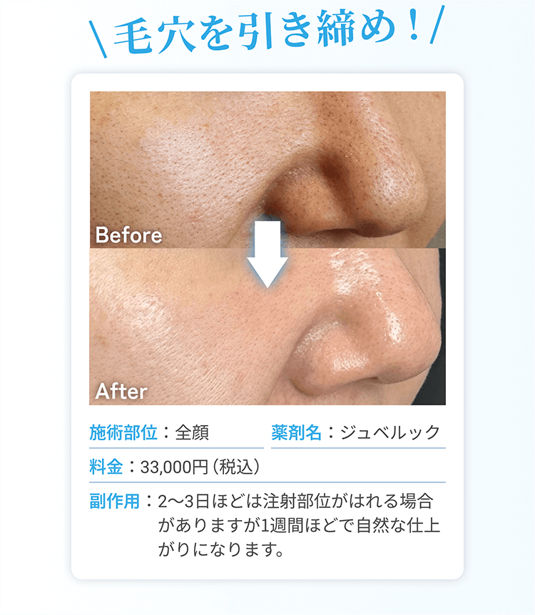毛穴を引き締め！施術部位：全顔 | 薬剤名：ジュべルック | 料金：額33,000円（税込）| 副作用：2~3日ほどは注射部位がはれる場合がありますが1週間ほどで自然な仕上がりになります。