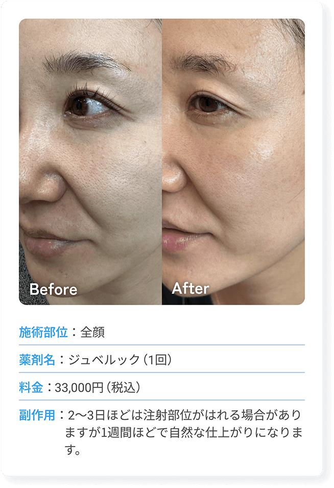 施術部位：全顔 | 施術名：新・水光注射（メソガン） | 料金：額33,000円（税込） | 副作用：2～3日ほどは注射部位がはれる場合がありますが1週間ほどで自然な仕上がりになります。