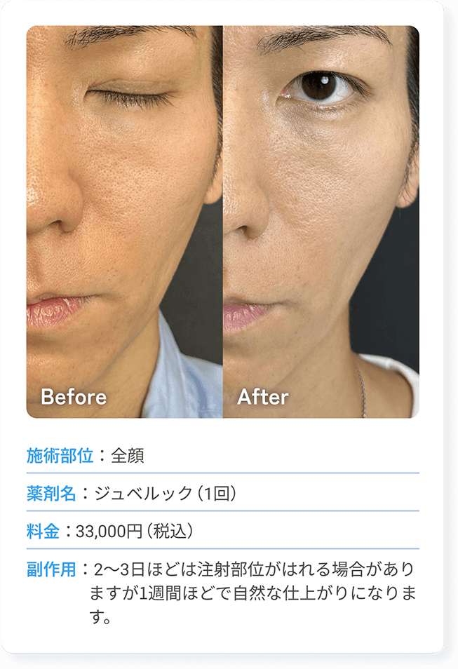 施術部位：全顔 | 施術名：新・水光注射（メソガン） | 料金：額33,000円（税込） | 副作用：2～3日ほどは注射部位がはれる場合がありますが1週間ほどで自然な仕上がりになります。